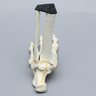 Foot and Ankle with Malleolar Fractures