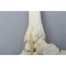 Foot and Ankle with Malleolar Fractures