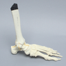 Foot and Ankle with Malleolar Fractures