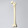 Femur with Subtrochanteric Oblique Fracture
