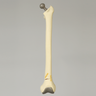 Femur with Distal Fracture and Implants