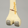 Femur with Distal Fracture and Implants