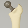 Femur with Distal Fracture and Implants