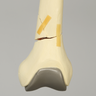 Femur with Distal Fracture and Implants