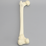 Femur with Nonunion and Displaced Malunion
