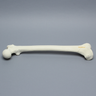 Femur with Supracondylar Fracture