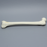 Femur with Supracondylar Fracture