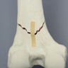 Femur with Supracondylar Fracture