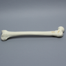 Femur with Intertrochanteric Three-Part Fracture