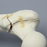 Femur with Intertrochanteric Three-Part Fracture