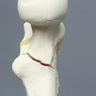 Femur with Intertrochanteric Three-Part Fracture