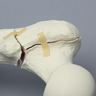Femur with Intertrochanteric Three-Part Fracture
