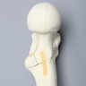Femur with Intertrochanteric Fracture and Small Fragment