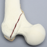 Femur with Intertrochanteric Fracture and Small Fragment