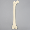 Femur with Subtrochanteric Spiral Fracture