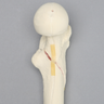 Femur with Subtrochanteric Spiral Fracture