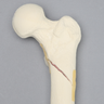Femur with Subtrochanteric Spiral Fracture