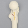 Femur with Subtrochanteric Spiral Fracture