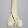 Femur with Bicondylar and Congenital Fractures