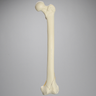 Femur with Bicondylar and Congenital Fractures