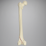 Femur with Bicondylar and Congenital Fractures