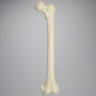 Femur with Bicondylar and Congenital Fractures