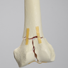 Femur with "T" Fracture