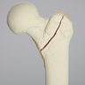 Femur with Intertrochanteric Fracture with Fragment