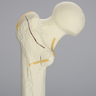 Femur with Intertrochanteric Fracture with Fragment