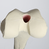 Stryker Femur for Exeter Plug and Stem