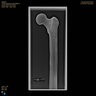 Femur, Radiopaque, Left