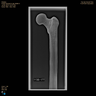 Femur, Radiopaque, Left