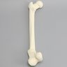 Femur with Nonunion and Malunion
