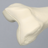 Femur with Osteoporosis, Osteoporotic Cortical Shell