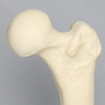 Femur with Osteoporosis, Osteoporotic Cortical Shell