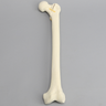 Femur with Three-Part Fracture