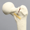Femur with Three-Part Fracture