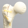 Femur with Three-Part Fracture