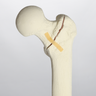 Femur with Oblique and "T" Fractures