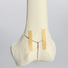 Femur with Oblique and "T" Fractures