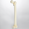 Femur with Oblique and "T" Fractures