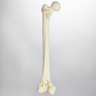 Femur with Oblique and "T" Fractures