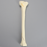 Tibia with Condylar, Oblique, and Spiral Fractures
