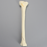 Tibia with Condylar, Oblique, and Spiral Fractures