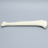 Tibia with Condylar Fracture