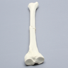 Tibia with Small Butterfly Fracture