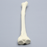 Tibia with Distal Malunion and 25 Degree Varus Defect, Foam Cortical