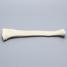 Tibia with Distal Malunion and 25 Degree Varus Defect, Foam Cortical