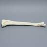 Tibia with Condylar, Malleolar, Oblique, and Spiral Fractures