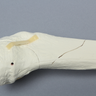 Tibia with Condylar, Malleolar, Oblique, and Spiral Fractures